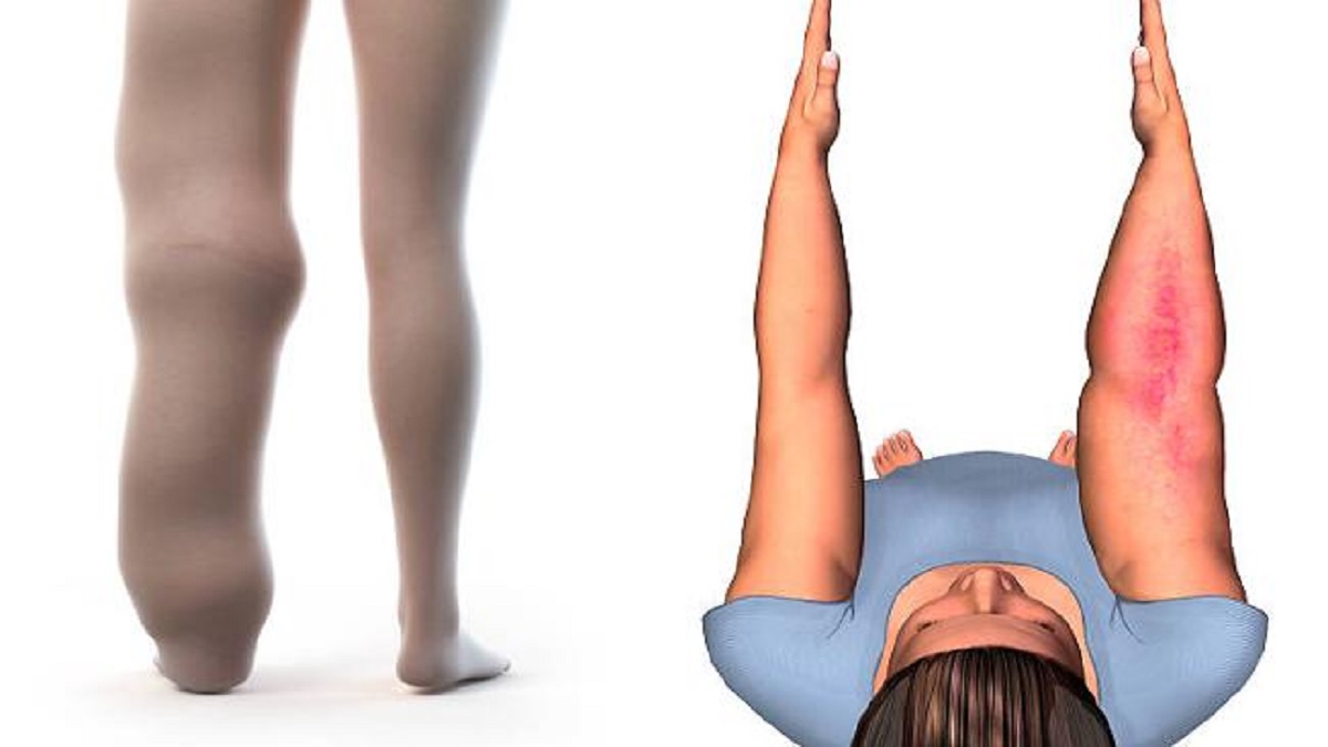 lymphedema lipedema symptoms treatment swollen and painful legs read the details in marathi nrvb